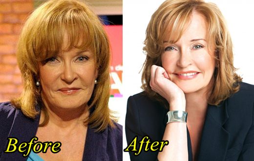 marilyn denis plastic surgery Image 4